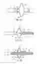 Fig. 17 - Telescoping ureteral stent