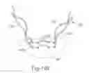 Fig. 41 - Method and apparatus for subretinal administration of therapeutic agent
