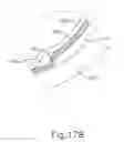 Fig. 43 - Method and apparatus for subretinal administration of therapeutic agent