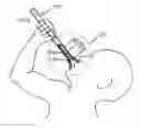 Fig. 01 - APPARATUS FOR LAUNCHING SUBCALIBER PROJECTILES AT PROPELLANT OPERATING PRESSURES INCLUDING THE RANGE OF PRESSURES THAT MAY BE SUPPLIED BY HUMAN BREATH