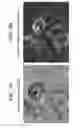 Fig. 04 - MULTIPLEXED METHOD FOR DIAGNOSING CLASSICAL HODGKIN LYMPHOMA