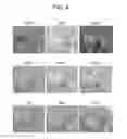 Fig. 05 - MULTIPLEXED METHOD FOR DIAGNOSING CLASSICAL HODGKIN LYMPHOMA