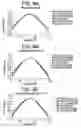 Fig. 10 - Presbyopia lens with pupil size correction based on level of refractive error