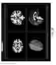 Fig. 11 - Multi-factor brain analysis via medical imaging decision support systems and methods