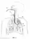 Fig. 08 - Methods and devices for passive residual lung volume reduction and functional lung volume expansion