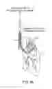 Fig. 10 - Methods and devices for passive residual lung volume reduction and functional lung volume expansion
