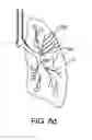 Fig. 12 - Methods and devices for passive residual lung volume reduction and functional lung volume expansion
