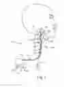 Fig. 02 - Apparatus for baroreceptor stimulation therapy
