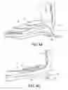 Fig. 04 - Prosthetic device, system and method for increasing vacuum attachment