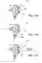 Fig. 10 - Prosthetic device, system and method for increasing vacuum attachment