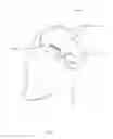 Fig. 02 - Implant for Treating Aneurysms