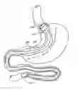 Fig. 01 - METHODS OF REPLACING A GASTROINTESTINAL BYPASS SLEEVE FOR THERAPY ADJUSTMENT