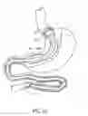 Fig. 02 - METHODS OF REPLACING A GASTROINTESTINAL BYPASS SLEEVE FOR THERAPY ADJUSTMENT