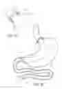 Fig. 06 - METHODS OF REPLACING A GASTROINTESTINAL BYPASS SLEEVE FOR THERAPY ADJUSTMENT
