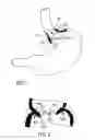 Fig. 09 - METHODS OF REPLACING A GASTROINTESTINAL BYPASS SLEEVE FOR THERAPY ADJUSTMENT