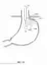 Fig. 28 - METHODS OF REPLACING A GASTROINTESTINAL BYPASS SLEEVE FOR THERAPY ADJUSTMENT