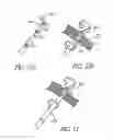 Fig. 40 - METHODS OF REPLACING A GASTROINTESTINAL BYPASS SLEEVE FOR THERAPY ADJUSTMENT