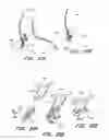 Fig. 44 - METHODS OF REPLACING A GASTROINTESTINAL BYPASS SLEEVE FOR THERAPY ADJUSTMENT