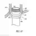 Fig. 49 - METHODS OF REPLACING A GASTROINTESTINAL BYPASS SLEEVE FOR THERAPY ADJUSTMENT