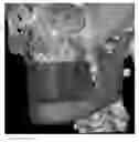 Fig. 01 - Custom reduction splint for edentulous patients