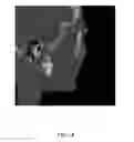 Fig. 03 - Custom reduction splint for edentulous patients