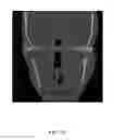 Fig. 04 - Custom reduction splint for edentulous patients
