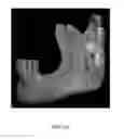 Fig. 05 - Custom reduction splint for edentulous patients
