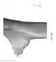 Fig. 07 - Custom reduction splint for edentulous patients