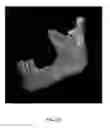 Fig. 09 - Custom reduction splint for edentulous patients