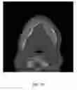 Fig. 12 - Custom reduction splint for edentulous patients