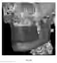 Fig. 16 - Custom reduction splint for edentulous patients