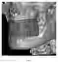Fig. 20 - Custom reduction splint for edentulous patients