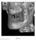 Fig. 22 - Custom reduction splint for edentulous patients