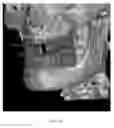 Fig. 23 - Custom reduction splint for edentulous patients