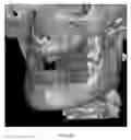 Fig. 24 - Custom reduction splint for edentulous patients