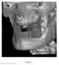 Fig. 25 - Custom reduction splint for edentulous patients