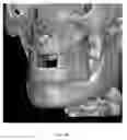 Fig. 26 - Custom reduction splint for edentulous patients