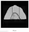 Fig. 28 - Custom reduction splint for edentulous patients
