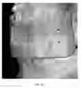 Fig. 34 - Custom reduction splint for edentulous patients