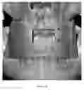 Fig. 44 - Custom reduction splint for edentulous patients