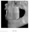 Fig. 46 - Custom reduction splint for edentulous patients