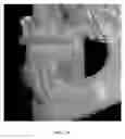 Fig. 47 - Custom reduction splint for edentulous patients