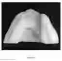 Fig. 49 - Custom reduction splint for edentulous patients