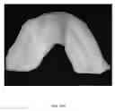 Fig. 50 - Custom reduction splint for edentulous patients