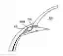 Fig. 01 - Glaucoma treatment device