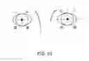 Fig. 33 - Glaucoma treatment device