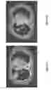Fig. 06 - Method of Treating Lung Adenocarcinoma