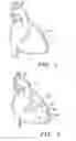 Fig. 02 - Method and system for treatment of cardiovascular disorders
