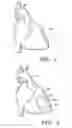 Fig. 02 - Method and system for treatment of cardiovascular disorders