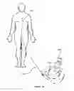 Fig. 08 - Delivery devices, systems and methods for delivering therapeutic agents